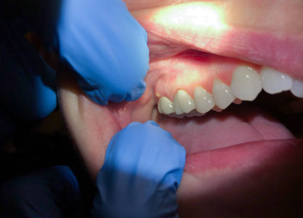 Best Emergency Wisdom Teeth Removal in Girard, PA